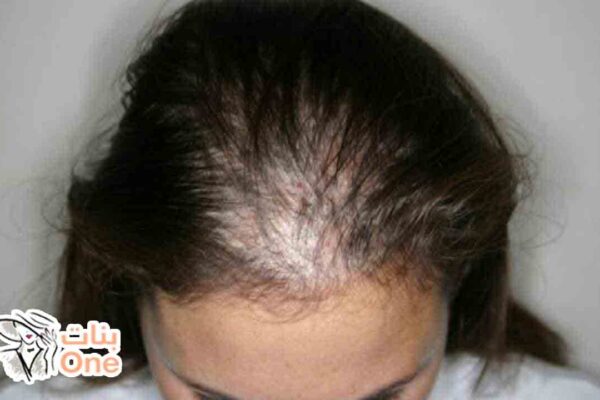 علاج تساقط الشعر طبيعياً  