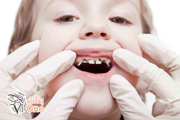أسباب تسوس الأسنان عند الأطفال  