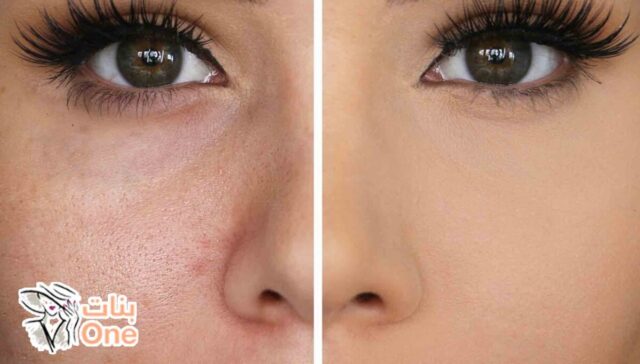 كيفية علاج مسامات الوجه  