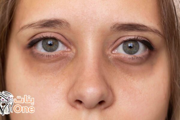 طرق علاج الهالات السوداء تحت العينين  