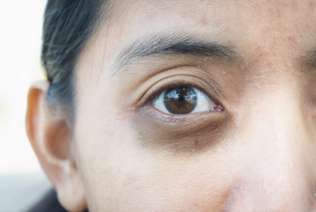طرق علاج الهالات السوداء تحت العينين  
