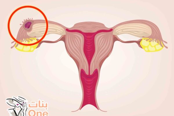 علامات الحمل خارج الرحم  