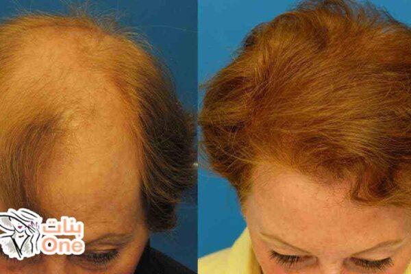 علاج تساقط الشعر بعد الصبغة  