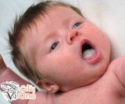 علاج فطريات الفم عند الرضع  